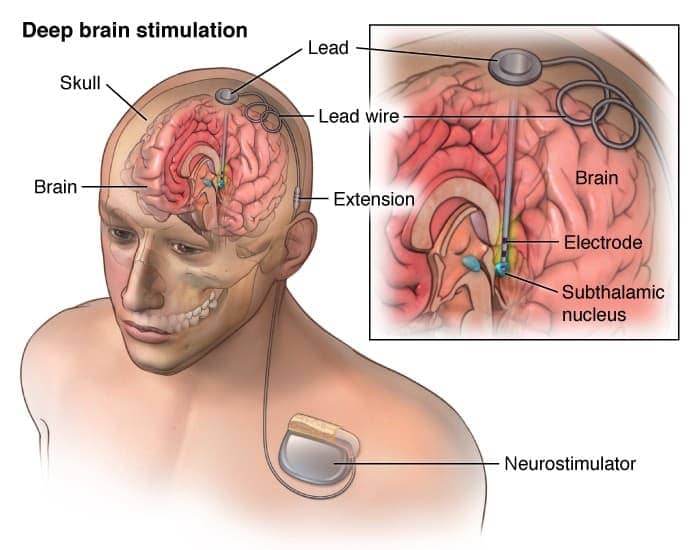 Image result for Deep Brain Stimulation