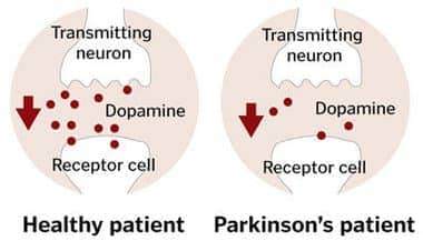 Image result for Parkinson neurotransmitter dopamine