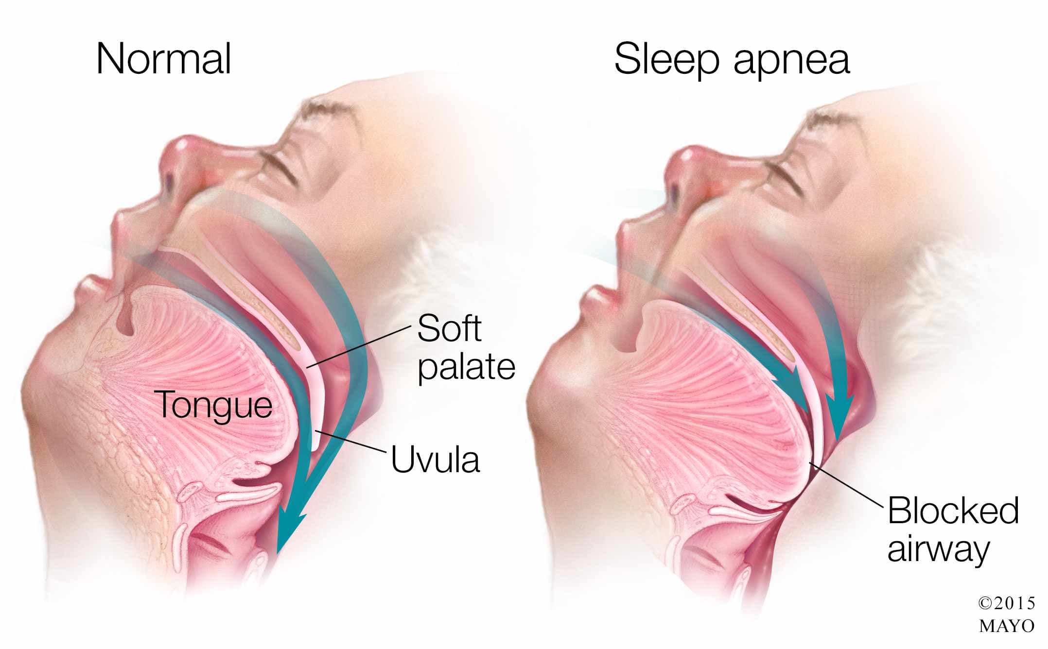 Image result for sleep apnea